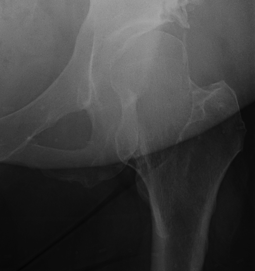 Hip Osteochondroma